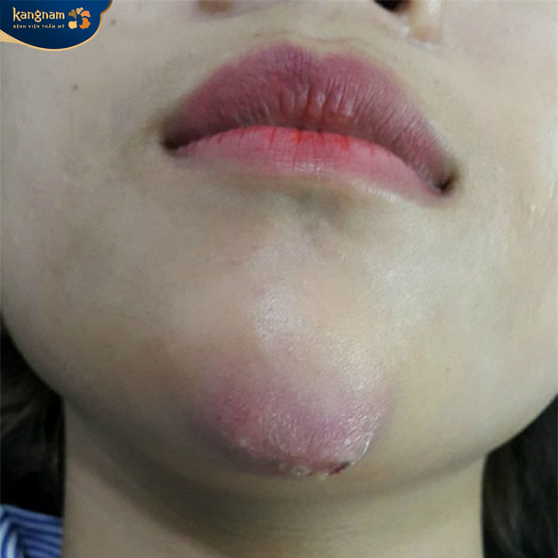 Cằm bị biến dạng do tiêm quá liều filler 