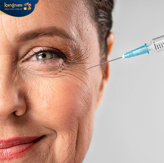 Chỉ nên tiêm duy trì khi filler cũ đã tan hết 