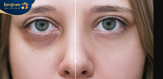 Sự khác biệt rõ ràng, đôi mắt trẻ trung hơn