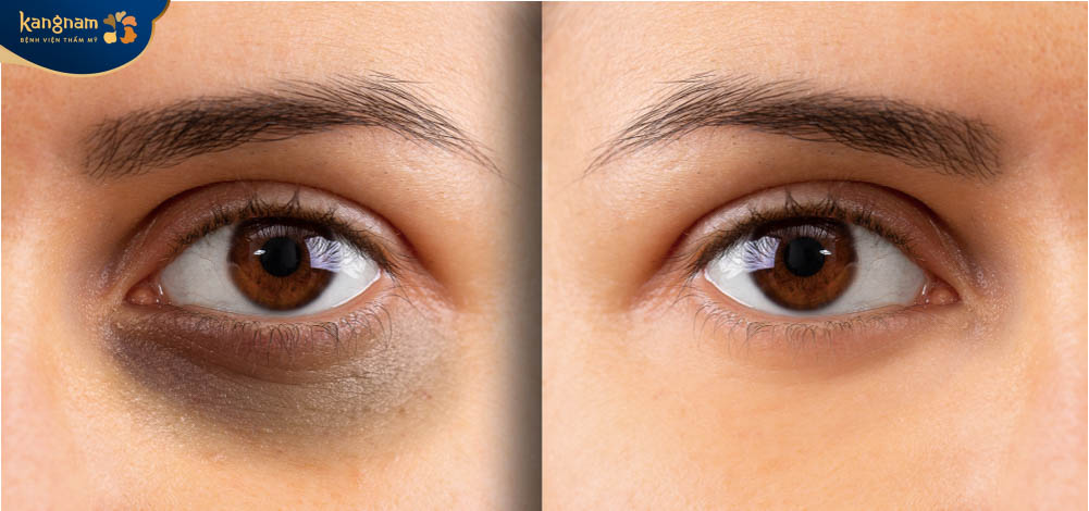 Tiêm chất làm đầy trị thâm mắt được kiểm định chất lượng an toàn, lành tính