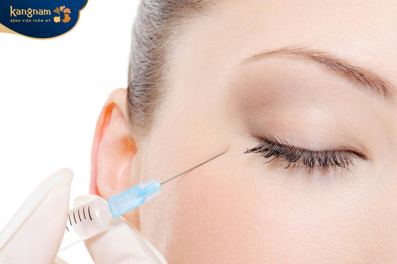 Tiêm filler trị thâm mắt giúp xóa tan quầng thâm, trẻ hóa đôi mắt.