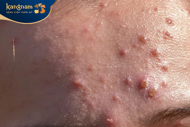 Mụn nang hình thành trên diện tích rộng