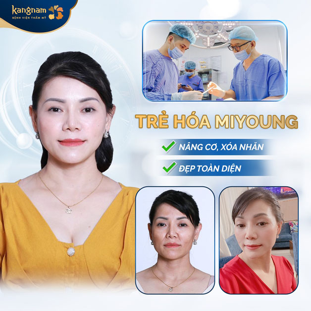 Căng chỉ trẻ hóa phù hợp với trường hợp lão hóa nhẹ đến trung bình