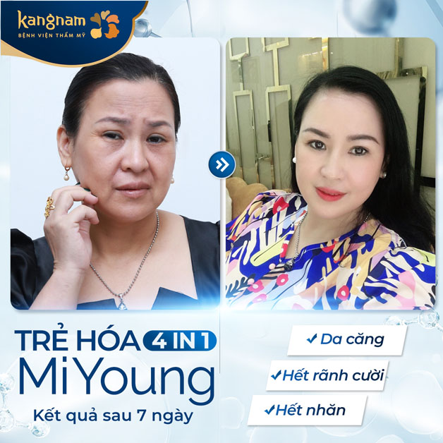 Khách hàng căng chỉ sau 1 tuần có kết quả đẹp tự nhiên