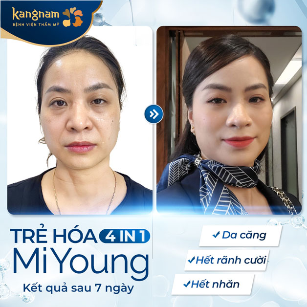 Căng chỉ an toàn cho làn da, cơ thể, khắc phục được nhiều khuyết điểm