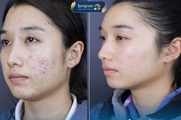 Điều trị hiệu quả mọi loại mụn bằng công nghệ tân tiến