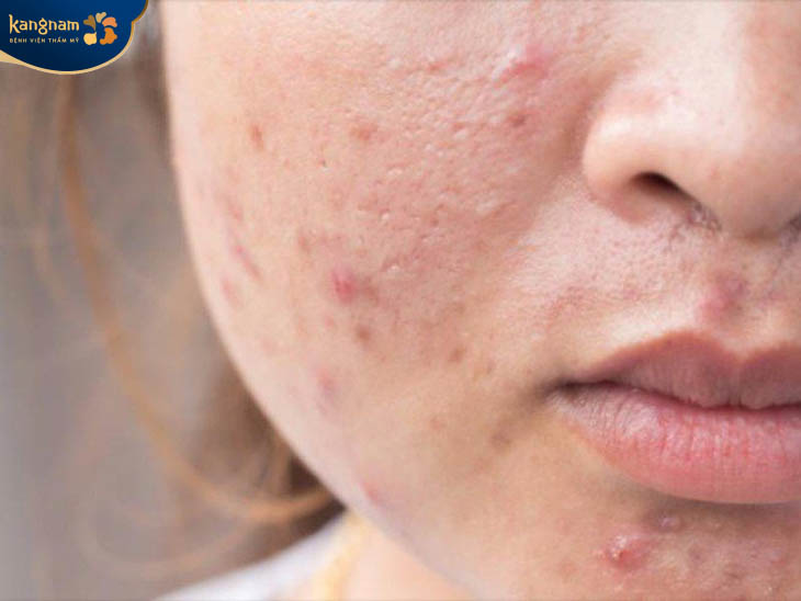 Không nên nặn mụn, sờ tay lên mặt khiến vết mụn viêm nhiễm nặng nề hơn