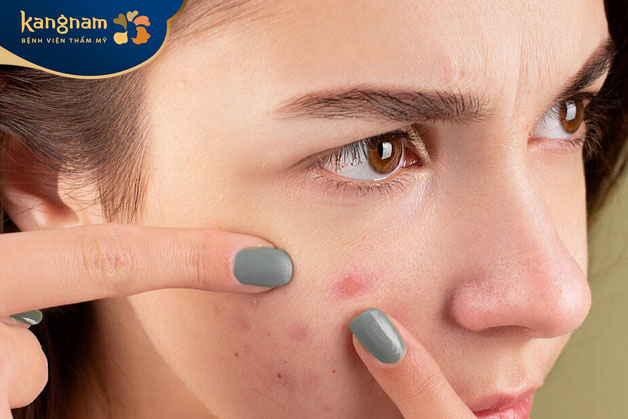 Nặn mụn nang dễ để lại sẹo thâm