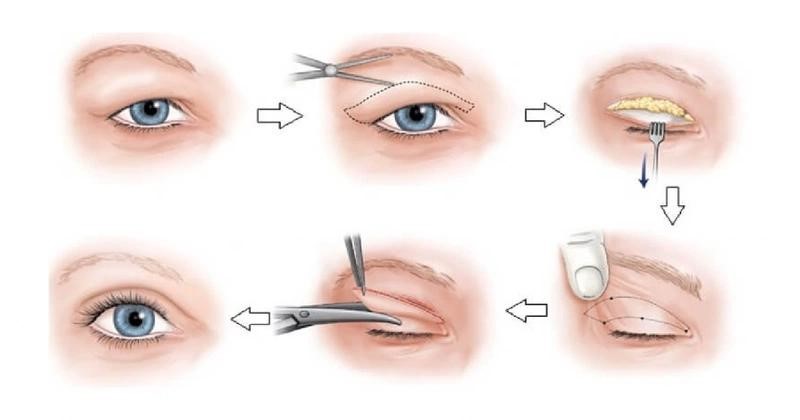 Kỹ thuật Cắt mí Plasma đình đám, duy trì nếp mí ổn định lâu năm