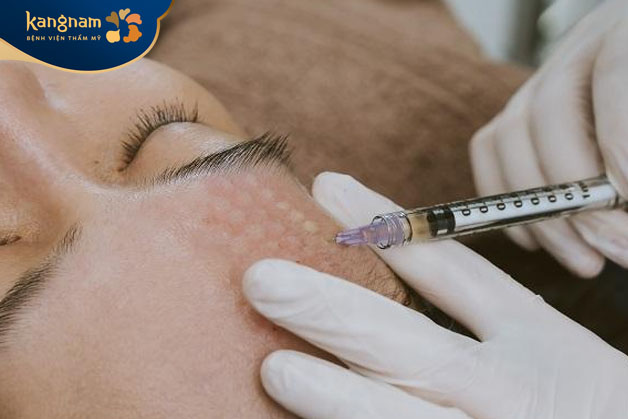 Meso Extra là phương pháp làm đẹp an toàn