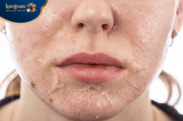 Da sưng đỏ sau peel