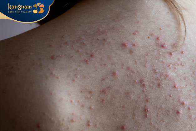 Mụn viêm, mụn ẩn sần suif