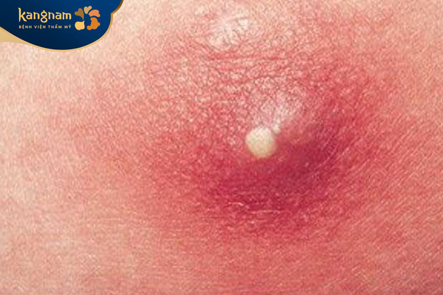 Mụn đinh xuất hiện trên bề mặt da với màu đỏ rực quanh vùng nổi mụn