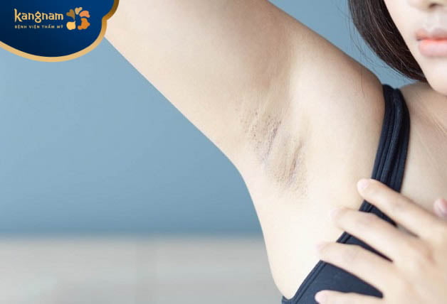 vệ sinh vùng da dưới cánh tay sai cách gây thâm nách