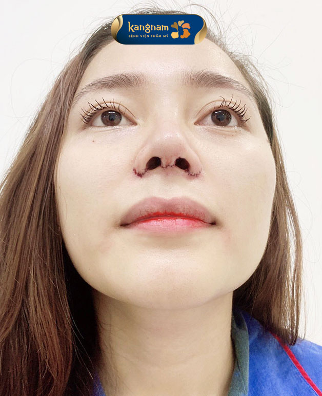 Cánh mũi sau khi phẫu thuật, ít sưng
