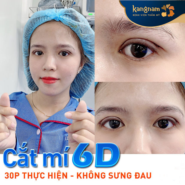 Công nghệ cắt mí 6D không sưng đau