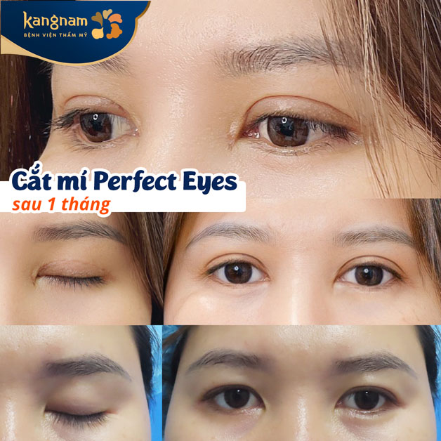 Cắt mí Perfect Eyes sau 1 tháng