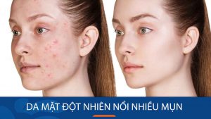 Da mặt nổi nhiều mụn đột ngột: Bí quyết lấy lại làn da mịn màng chỉ trong 3 ngày