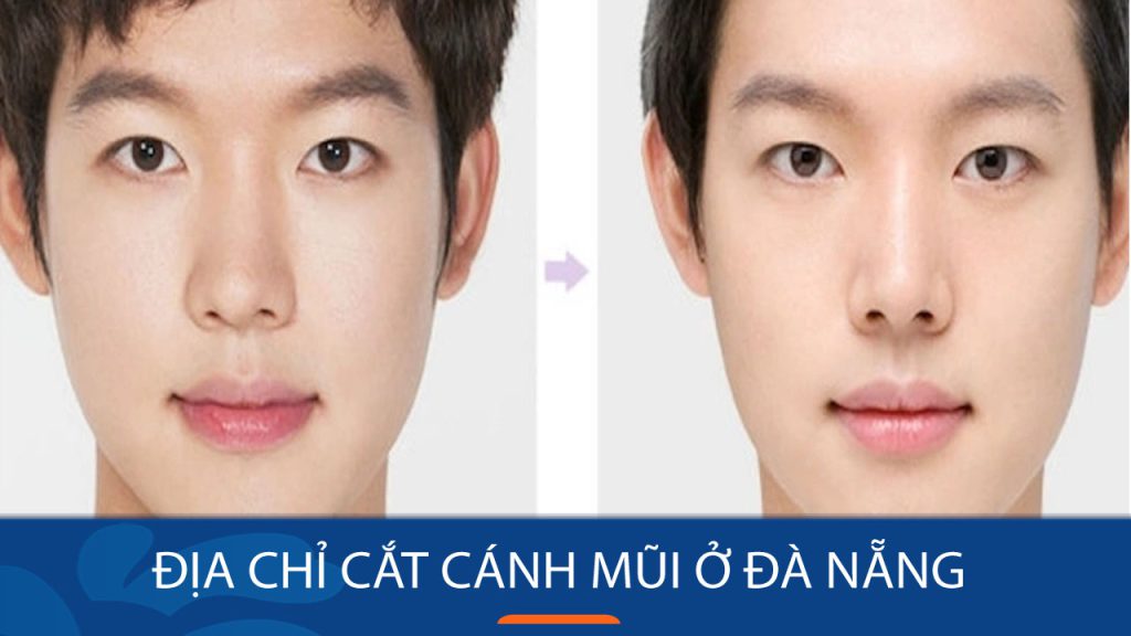 cắt cánh mũi kangnam Đà Nẵng chuyên nghiệp, mũi đẹp tự nhiên