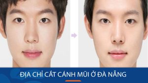 cắt cánh mũi kangnam Đà Nẵng chuyên nghiệp, mũi đẹp tự nhiên