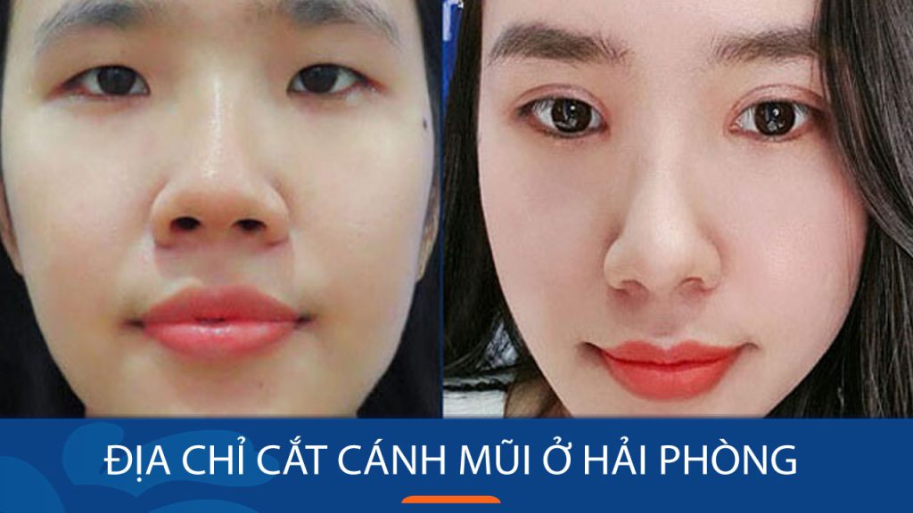 Địa chỉ cắt cánh mũi kangnam Hải Phòng: ĐẸP – KHÔNG ĐAU – AN TOÀN