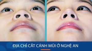 Địa chỉ cắt cánh mũi kangnam Nghệ An không đau, không sẹo