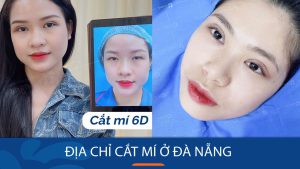 cắt mí kangnam Đà Nẵng Uy tín – 6 địa chỉ cắt mí hiện đại