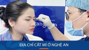 cắt mí kangnam Nghệ An thăng hạng vẻ đẹp đôi mắt của bạn