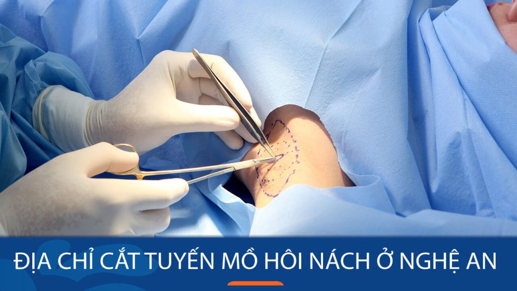 Địa chỉ cắt tuyến mồ hôi nách tại Nghệ An: Công nghệ Endo Dry an toàn, hiệu quả