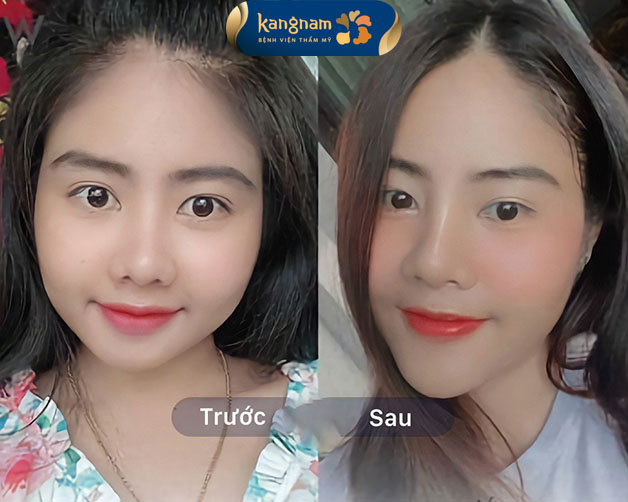 Khuôn mặt đẹp chuẩn V-line