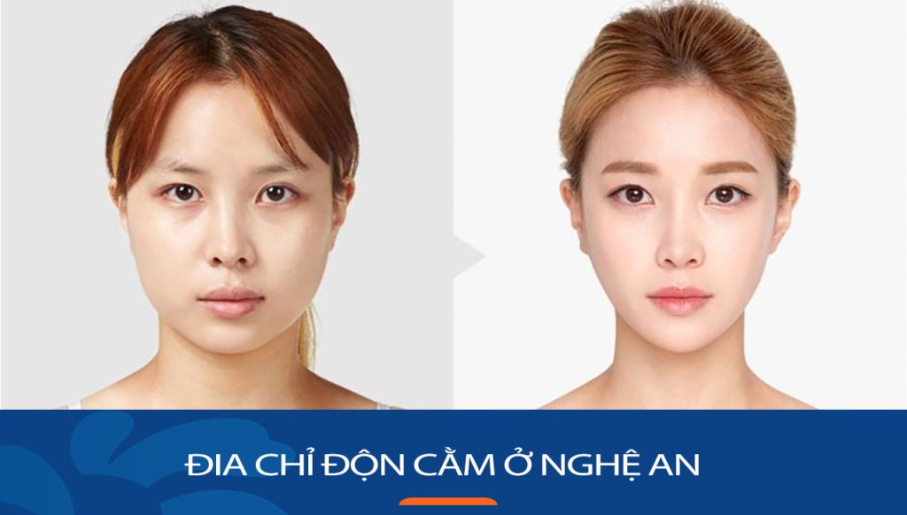 Độn cằm kangnam Nghệ An