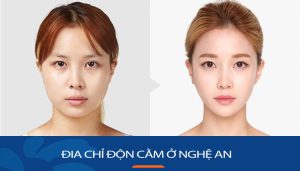 Độn cằm kangnam Nghệ An