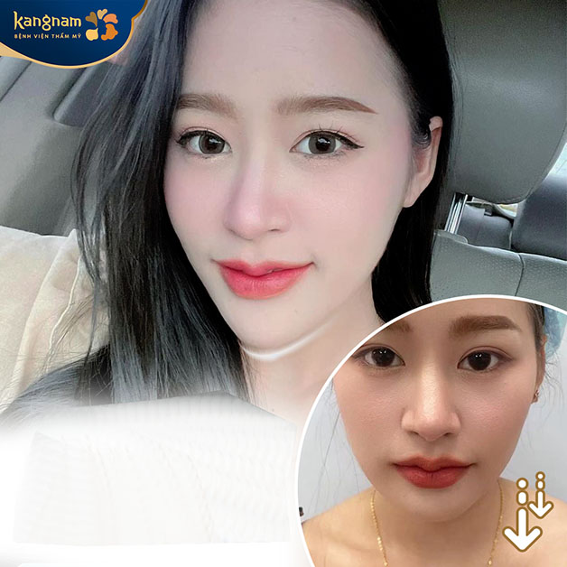 Kết quả khách hàng sau 3 tháng độn cằm tại Kangnam