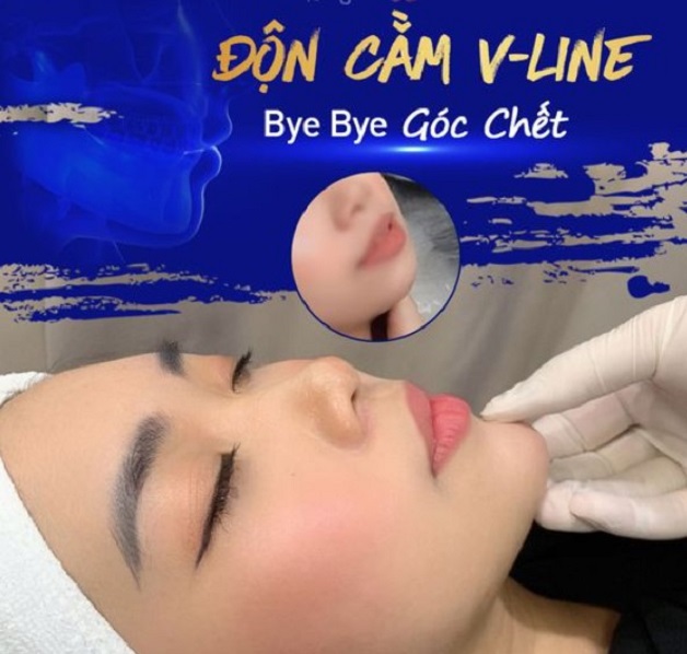 Độn cằm tự thân (Trượt cằm)