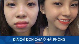 Độn cằm kangnam Hải Phòng