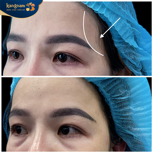 Vùng thái dương cải thiện trông thấy sau khi thực hiện dịch vụ tại Kangnam