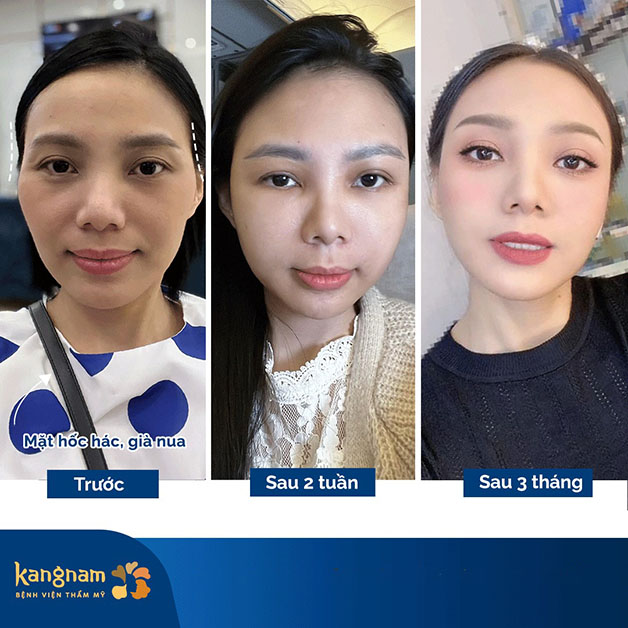 Kết quả sau 3 tháng thực hiện độn thái dương tại Kangnam, khuôn mặt khách hàng đầy đặn, không còn hốc hác như trước 