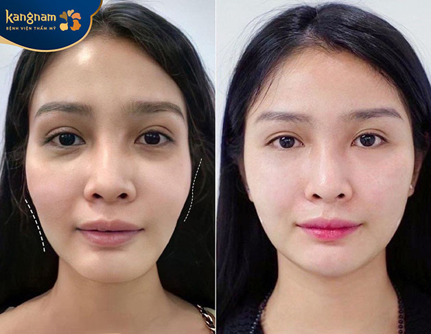 Chị Mai Hồng chia sẻ: "Sau khi thực hiện độn thái dương tại Kangnam, mình cảm thấy như trẻ ra chục tuổi. Mặt đầy đặn hơn cũng tự tin với diện mạo mới của mình". 