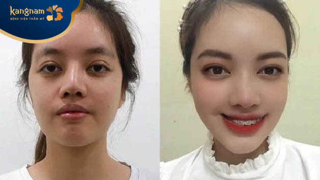 Khách hàng Lê Thủy sau 6 tháng độn thái dương tại Kangnam