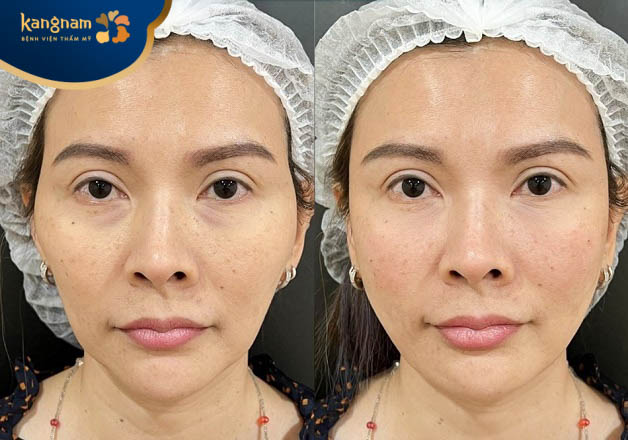 Chị Thanh Hiền hài lòng với kết quả sau độn thái dương tại Kangnam Nghệ An