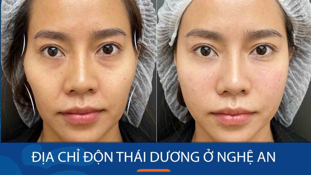 Độn thái dương kangnam Nghệ An