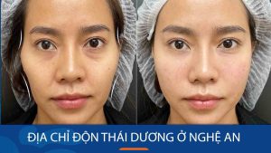 Độn thái dương kangnam Nghệ An