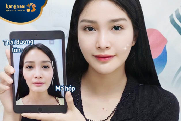 Tiêm filler lấp đầy thái dương an toàn, hiệu quả tức thì