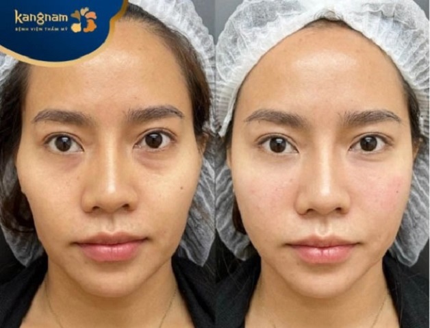 Tiêm filler thái dương giúp lấp đầy vùng da hõm, thiếu cân đối