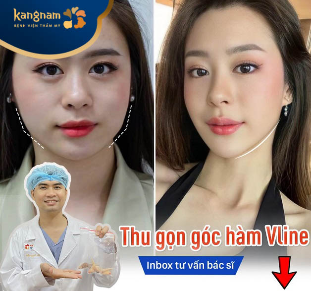 Gọt hàm Vline 3D