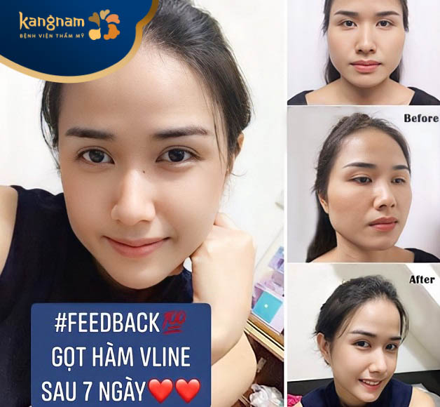 Chị Mai Thùy mừng rỡ vì đã được tái sinh nhan sắc sau gọt hàm