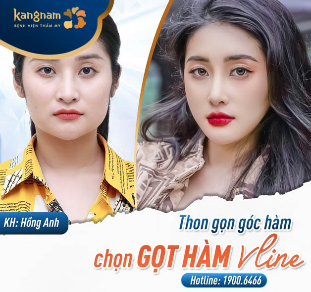 Hồng Anh trước và sau gọt hàm