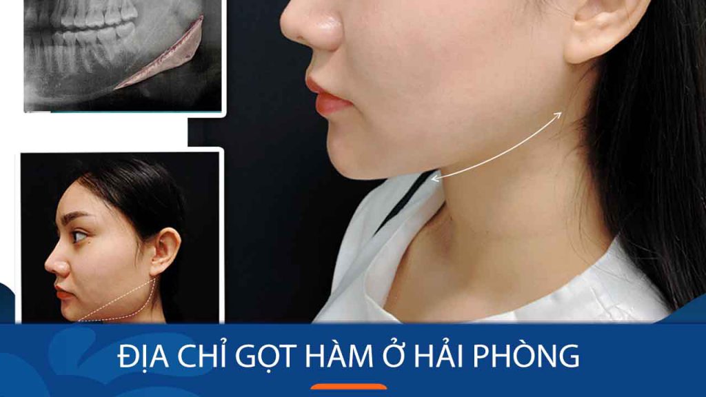 Gọt hàm kangnam Hải Phòng