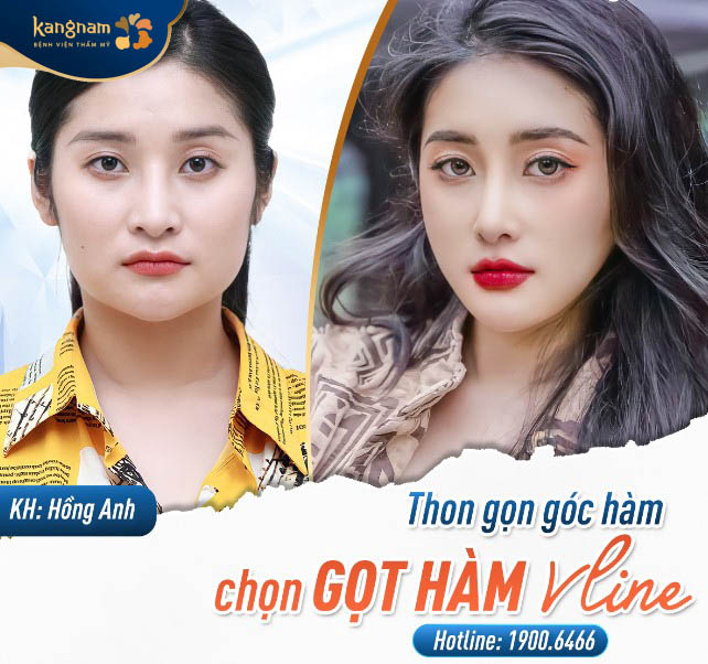 Diễn viên Hồng Anh sở hữu khuôn mặt cân đối, đẹp tự nhiên và nhận được nhiều lời mời diễn xuất, đóng quảng cáo sau gọt hàm tại Kangnam