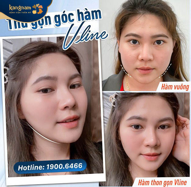 Thu gọn hàm vuông, cân đối với với khuôn mặt